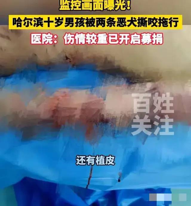 恶犬发威！哈尔滨10岁男孩头部与双脚被恶犬撕扯，令人心疼！